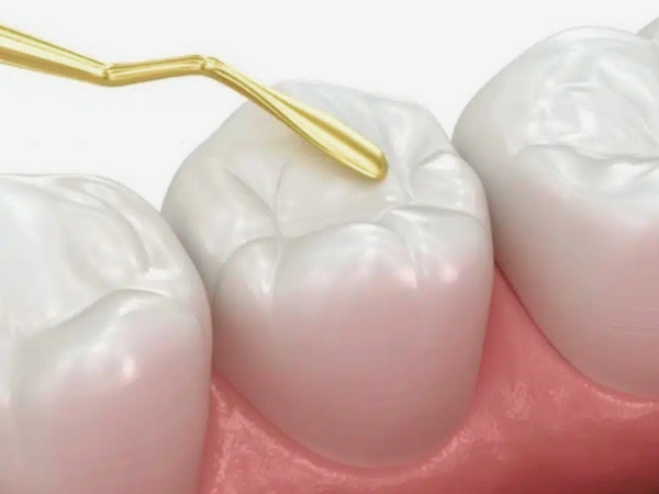 마곡 치과 _2. 씹을 때 치아 통증 치료 방법, 원인에 따라 달라집니다 관련 이미지 2