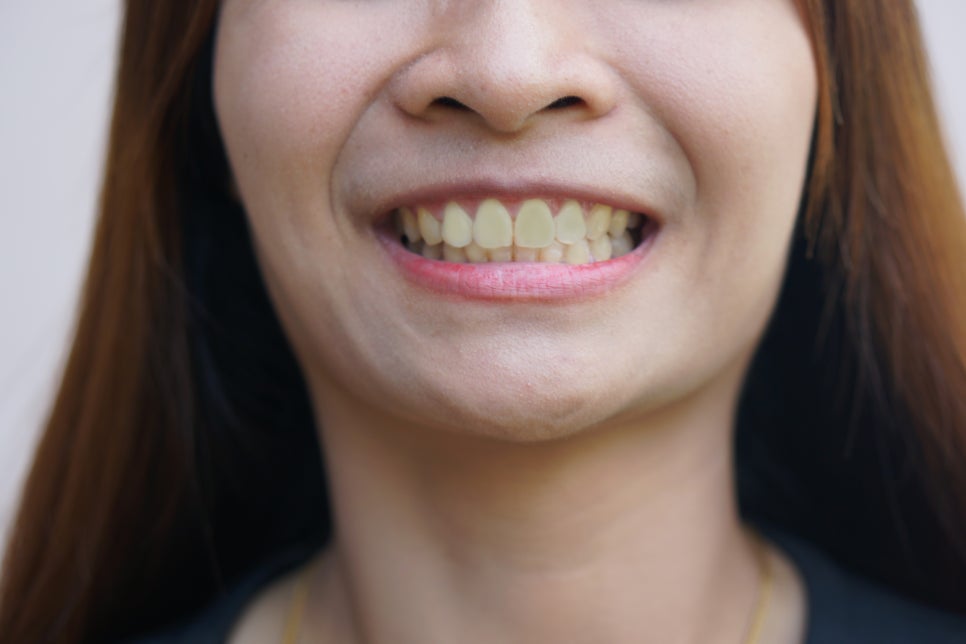 [ Magok Teeth Whitening_01 ] One-Day Teeth Whitening: How Do Teeth Become Whiter? image 1