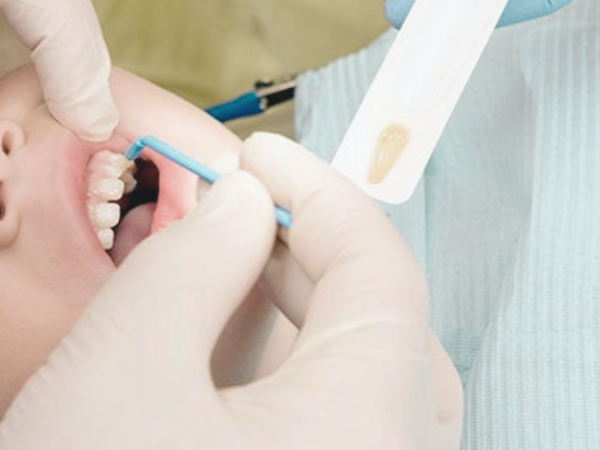 마곡동치과_&ldquo;불소, 치아를 어떻게 지켜주는 걸까?&rdquo;[1. 불소의 원리와 작용] 관련 이미지 6