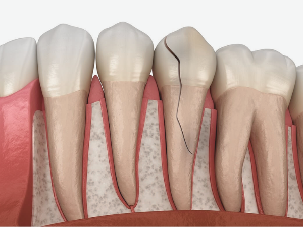 마곡치과_3. 씹을 때 아픈 치아, 그냥 참아도 괜찮을까요? 방치하면 생기는 문제 관련 이미지 1