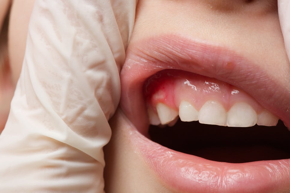 [ Magok Teeth Whitening_06 ] Can Anyone Get Teeth Whitening? Suitable and Unsuitable Cases image 3
