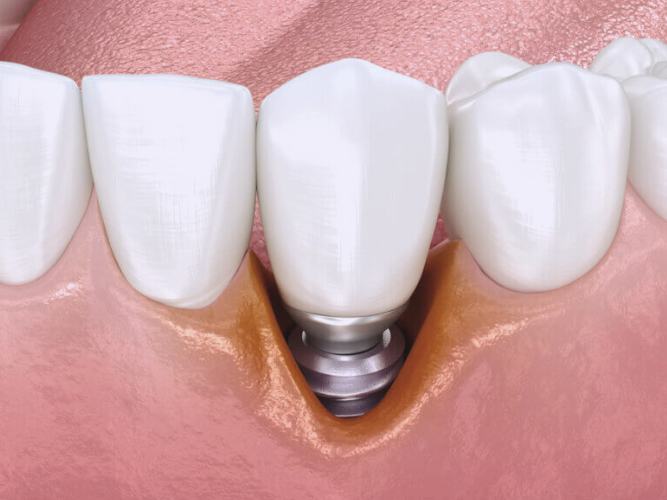 마곡역치과_"내 치아를 지키는 가장 스마트한 선택" [ 4. 임플란트 장점과 단점 ] 관련 이미지 8