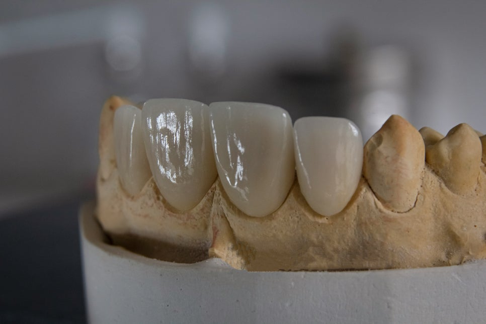[ Magok Veneers_05 ] How Long Do Veneers Last? image 2