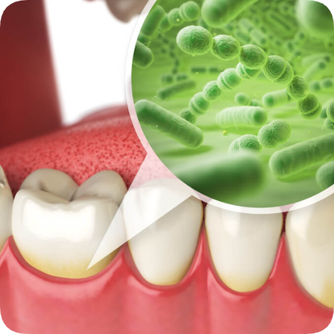 마곡동치과_1. 치주질환이란? (치은염과 치주염의 차이점) 관련 이미지 4