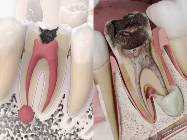 마곡역치과_2. 치수염 통증은 어떻게 나타날까요? 급성, 만성 치수염 증상 관련 이미지 1