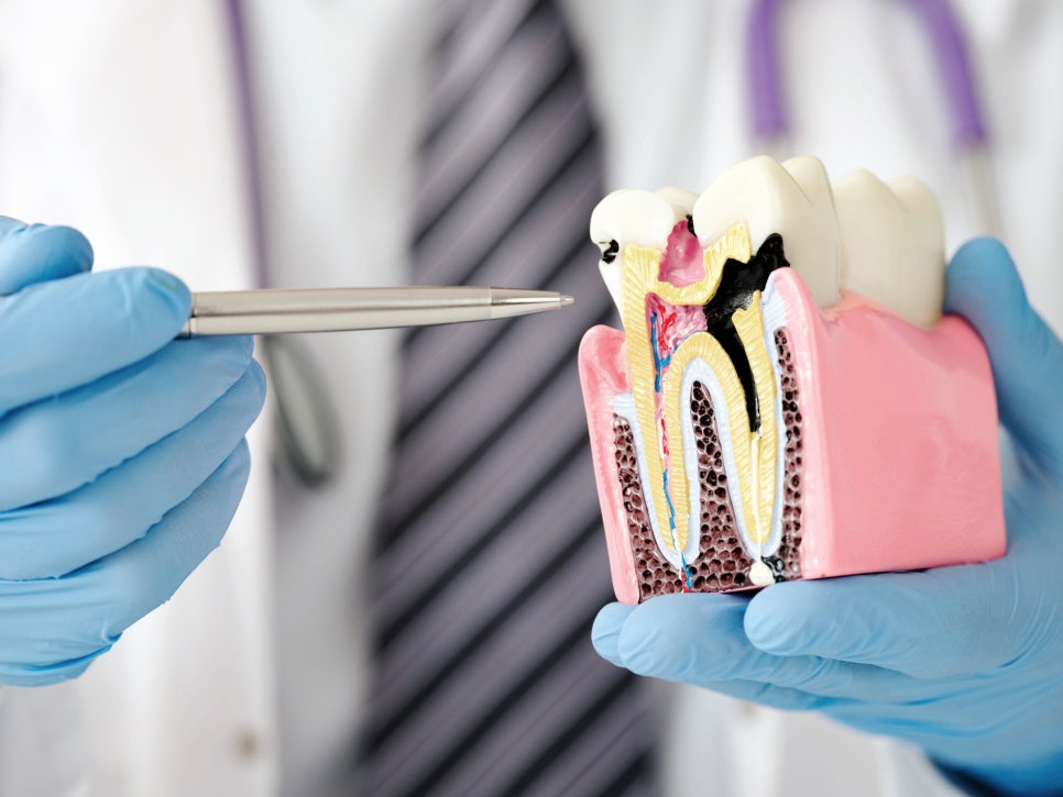 마곡동치과_ &ldquo;아무도 모르게, 아주 조용히&rdquo; [1. 충치가 생기는 과정 ] 관련 이미지 1