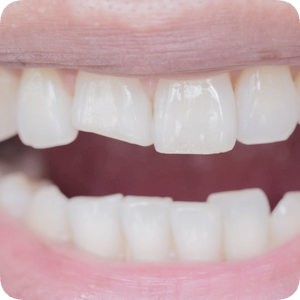 마곡치과_"이럴 땐 레진이 답입니다" [ 1. 치과 레진 활용법 ] 관련 이미지 5