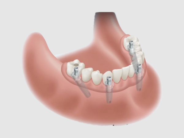 마곡역치과_"상담부터 완성까지" [ 4. 임플란트 틀니 치료 과정 ] 관련 이미지 5