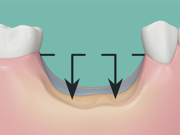 [ 마곡동치과_치아 상실 1 ] 이가 빠지면 생기는 문제, 방치하면 어떻게 될까요? 관련 이미지 4