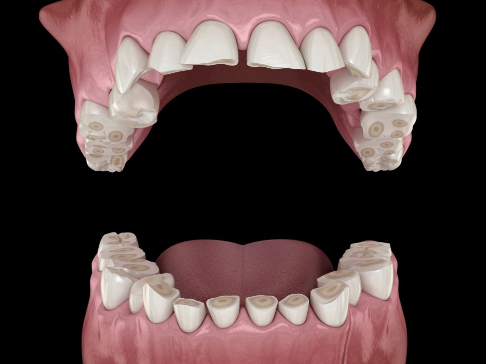 마곡동치과_5. 중년기 초입(30~40대) 치아 잇몸 변화와 구강관리 포인트 관련 이미지 3