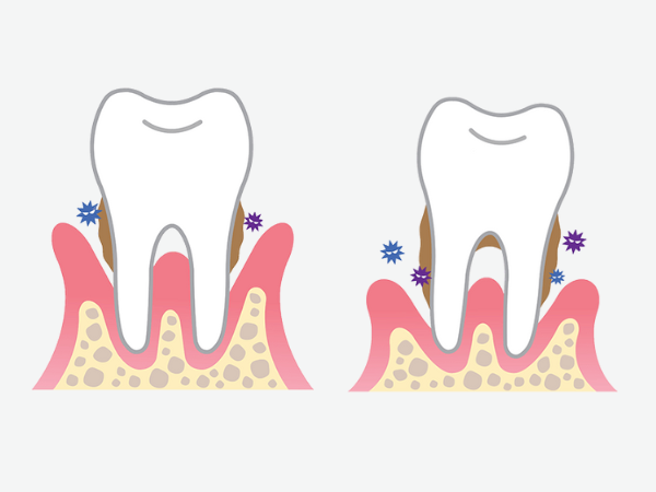 Maggok Dental_4. Is it over once the jawbone has melted away? How to save natural teeth with guided tissue regeneration (GTR) image 6