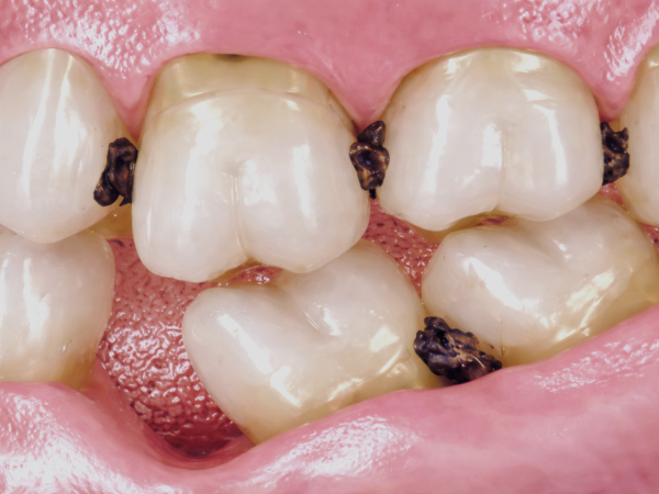 [ 마곡동치과_치아 상실 1 ] 이가 빠지면 생기는 문제, 방치하면 어떻게 될까요? 관련 이미지 5