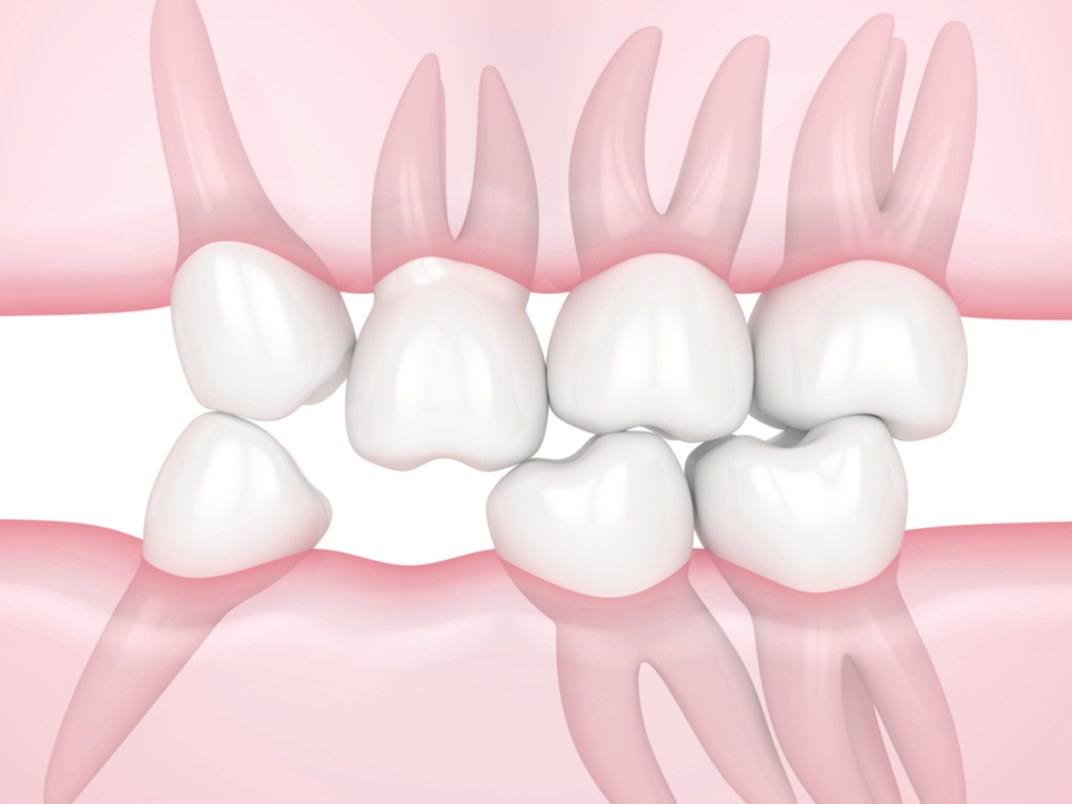 [ 마곡동치과_치아 상실 1 ] 이가 빠지면 생기는 문제, 방치하면 어떻게 될까요? 관련 이미지 3