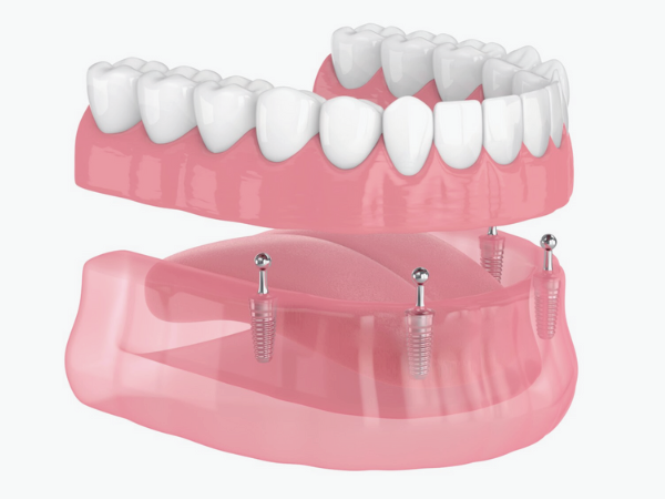 마곡동치과_ &ldquo;내 입에 딱! 맞는 선택은?&rdquo; [ 5. 임플란트 틀니 종류와 특징 ] 관련 이미지 2