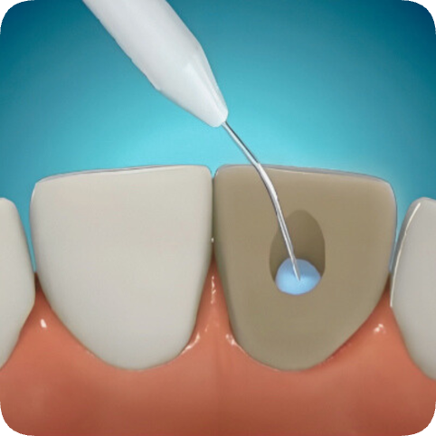 마곡역치과_ 신경이 죽은 치아를 다시 하얗게! [ 2. 실활치 미백&rsquo;의 원리와 과정 ] 관련 이미지 5