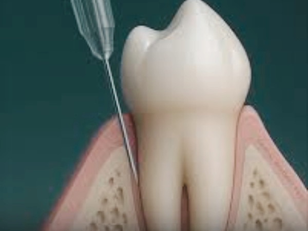 마곡동치과_1. 치과 국소마취, 종류별로 뭐가 다를까요? 관련 이미지 4