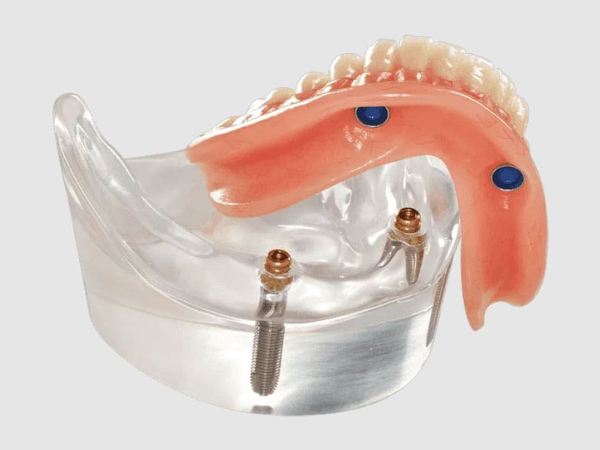 마곡동치과_ &ldquo;틀니와 임플란트의 만남&rdquo; [ 1.임플란트 틀니란? ] 관련 이미지 3