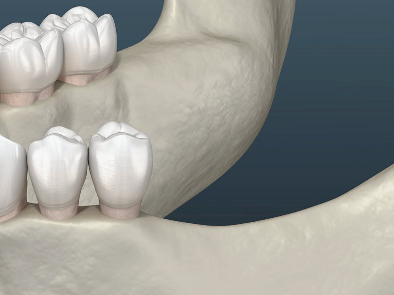 마곡동치과_ "오늘 뽑고 심는 임플란트, 정말 괜찮을까?" [ 2. 당일 임플란트 장점 단점 ] 관련 이미지 4