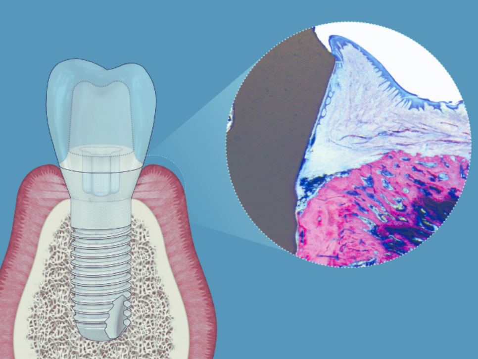마곡치과_"긁지 말고, 부드럽게 관리!" [ 2. 임플란트 전용 에어플로우 스케일링 ] 관련 이미지 1