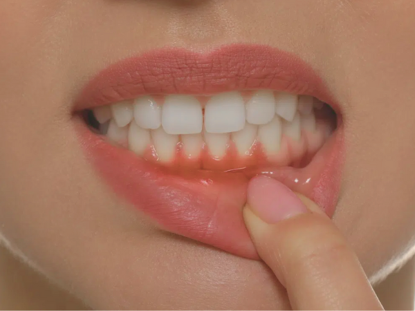 마곡동치과_2. 잇몸재생주사 PDRN, 효과를 기대해도 되는 경우 vs 어려운 경우 관련 이미지 2