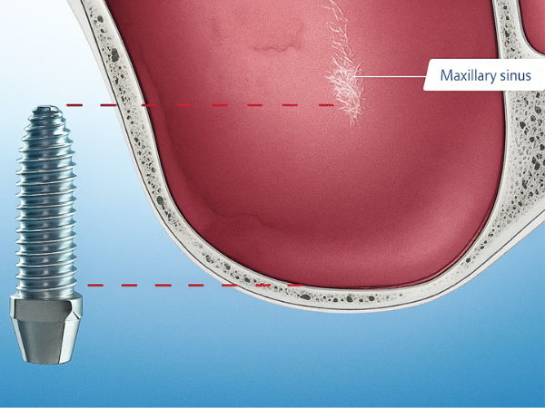 마곡역치과_1. 상악동거상술이란? 위턱 임플란트 전 꼭 알아야 할 정의와 적응증 관련 이미지 5