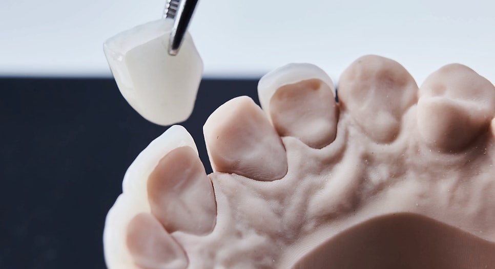 마곡역치과_3. 무삭제 라미네이트(디아네이트) 시술 과정 관련 이미지 7