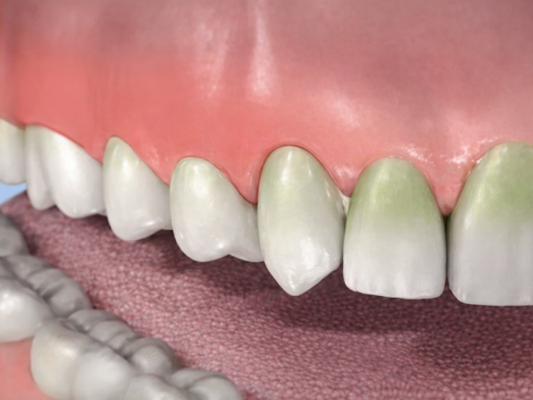 마곡역치과_4. 성인 초기(20~30대) 치아 문제 늘어나는 이유와 구강관리 핵심 관련 이미지 3