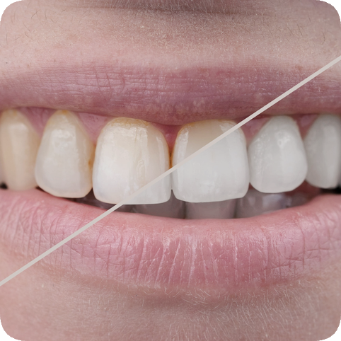 마곡역치과_ 하얀 이가 누렇게 변했다? [ 1. 치아변색의 원인 ] 관련 이미지 1