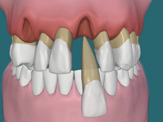 마곡동치과_1. 임플란트 치료에 관련 이미지 3