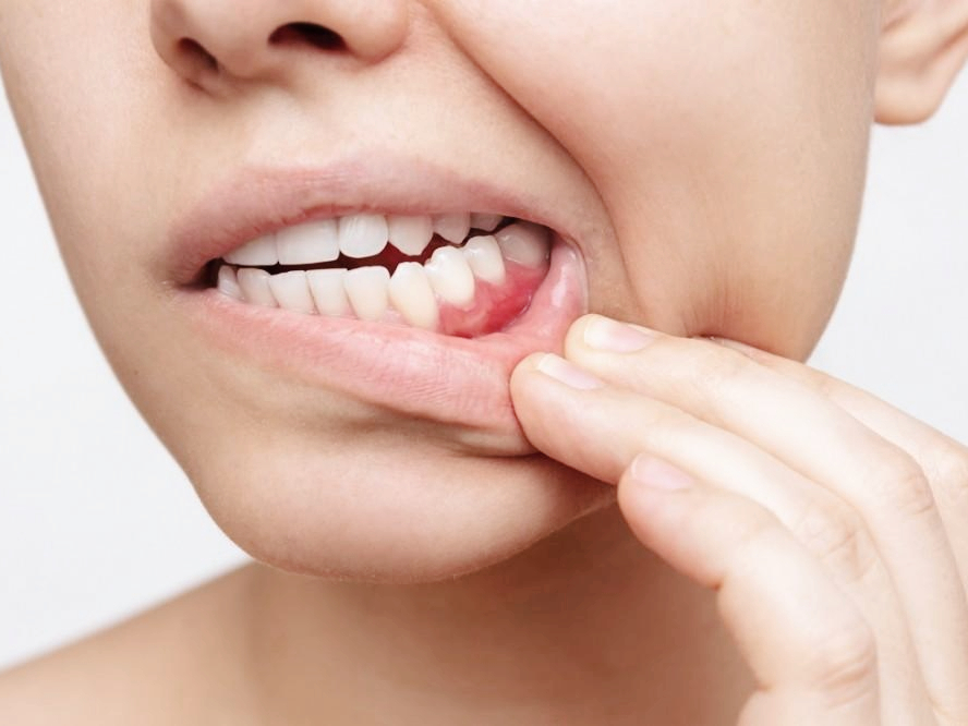 마곡역치과_&ldquo;씹을 때 찌릿? 시릴 때 번쩍?&rdquo;[2. 치아 금(균열) 증상] 관련 이미지 4