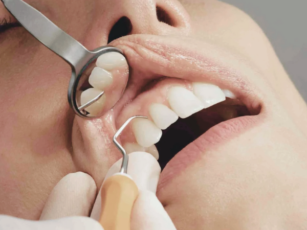 마곡역치과_2. 스케일링 주기, 얼마나 자주 받아야 할까? 소요시간까지 총정리 관련 이미지 1