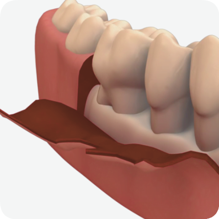 마곡동 치과_5. 치주질환 치료, 어디까지 해봤니? 단계별 잇몸 관리 총정리 관련 이미지 5