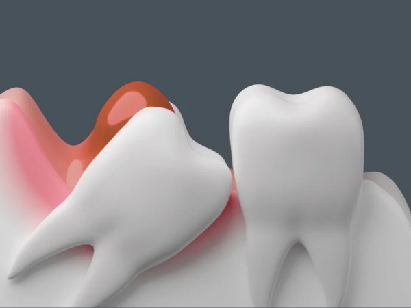 마곡동치과_1. 사랑니, 가장 늦게 가장 깊이 나는 치아? 위치와 맹출 시기 총정리 관련 이미지 3