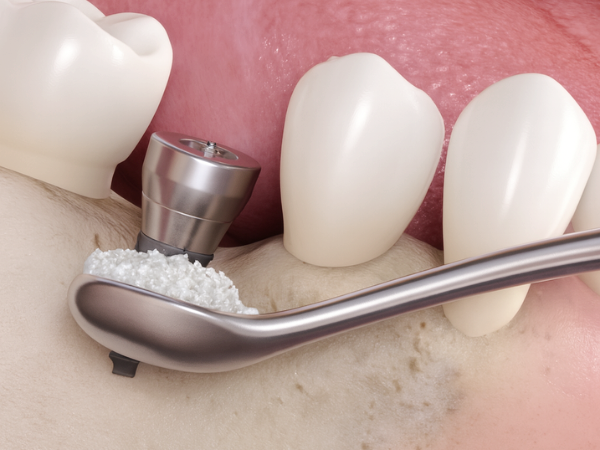 마곡동치과_ &ldquo;안전한 준비, 깔끔한 진행!&rdquo; [ 4. 당일 임플란트 수술 과정 ] 관련 이미지 4