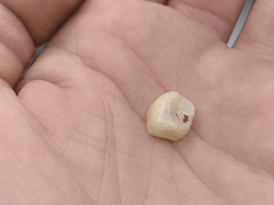 마곡역치과_ "보철물 씌웠다고 끝? 진짜 관리는 지금부터!" [ 4. 신경치료 후 크라운 관리법 ] 관련 이미지 4