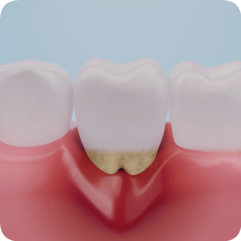 마곡동치과_1. 치주질환이란? (치은염과 치주염의 차이점) 관련 이미지 6