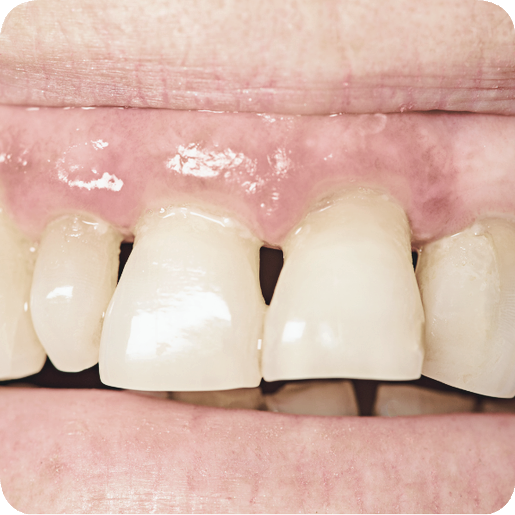 마곡동치과_2. 무삭제 라미네이트가 불가능한 경우 관련 이미지 4