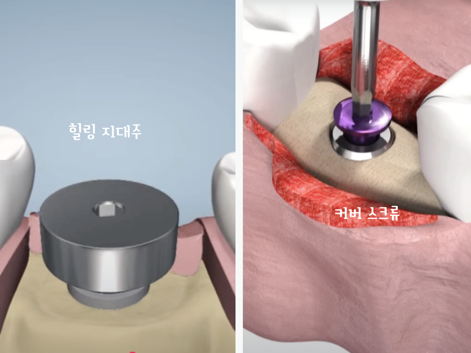 마곡역치과_"씹는 즐거움, 웃는 자신감, 내 이 같은 자연스러움" [ 3. 임플란트 수술과정 ] 관련 이미지 4