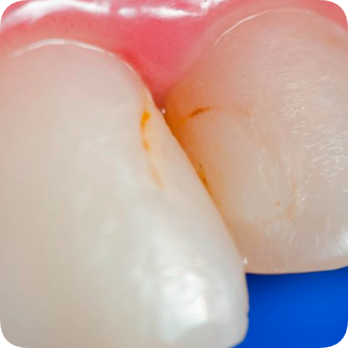 마곡치과_&ldquo;레진의 매력, 알면 선택이 쉬워집니다&rdquo; [ 2. 레진의 장,단점과 비용 ] 관련 이미지 3