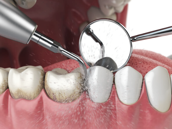 마곡동치과_ 2. 스케일링 주기와 소요 시간, 내 입속 상황에 맞게 꼭 알아야 할 포인트! 관련 이미지 1