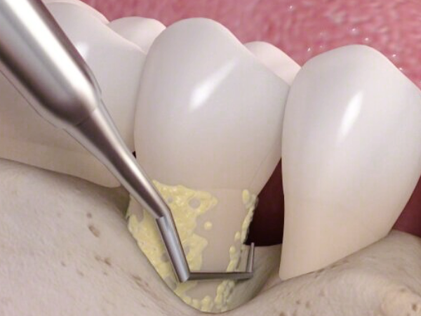 마곡동치과_ 2. 스케일링 주기와 소요 시간, 내 입속 상황에 맞게 꼭 알아야 할 포인트! 관련 이미지 4