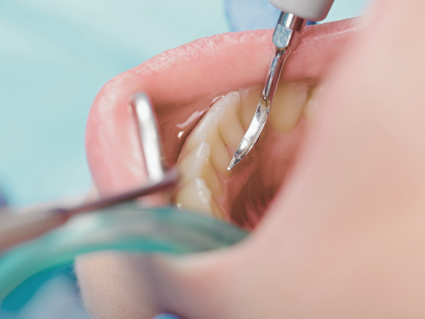 마곡역치과_2. 스케일링 주기, 얼마나 자주 받아야 할까? 소요시간까지 총정리 관련 이미지 7