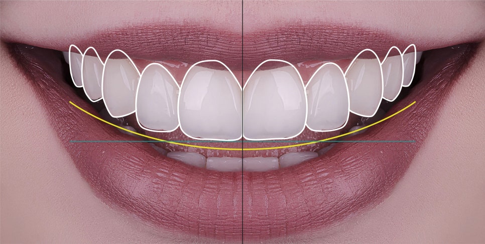 마곡역치과_3. 무삭제 라미네이트(디아네이트) 시술 과정 관련 이미지 5