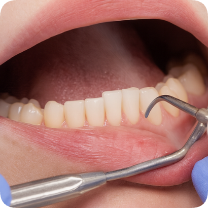 마곡치과_"스케일링에도 스타일이 있다?" [ 3. 에어플로우와 일반 스케일링 비교 ] 관련 이미지 3