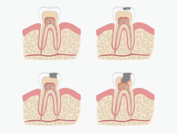 마곡역치과_1. 치수염이란? 치아 속 신경에 염증이 생기는 이유 관련 이미지 3