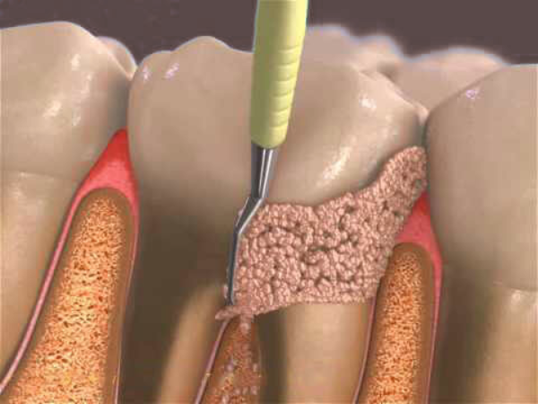 Maggok Dental_2. Why root planing and curettage are needed when scaling is not enough image 2