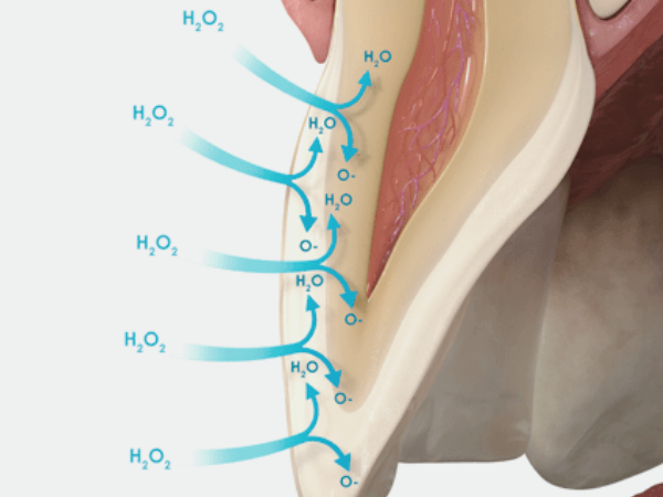 마곡치과_"삭제없이 환하게" [1. 치아 미백치료 원리] 관련 이미지 4