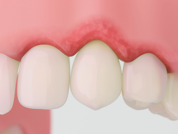 Maggok-dong Dental Clinic_“Signs That Your Gums Are Receding” [2. Step-by-Step Progression of Gingival Recession and Self-Diagnosis Checklist] image 1