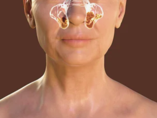 마곡동 치과_2. 상악동거상술 위험한가요? 부작용 현실 기준 정리 관련 이미지 2