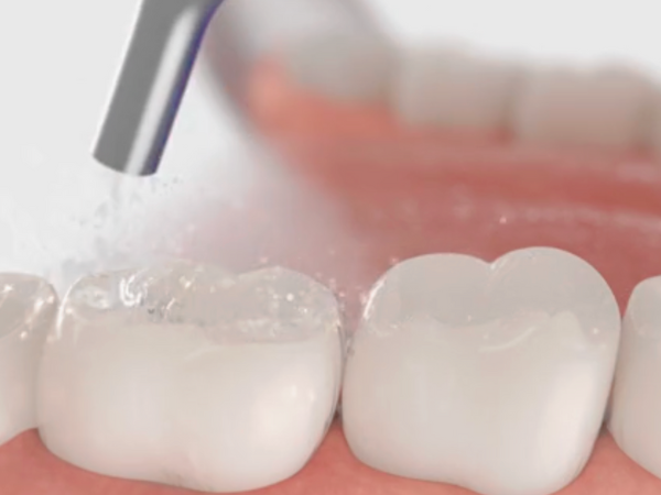 Magaok Station Dental Clinic_ &ldquo;It doesn’t hurt and it’s over quickly&rdquo; [3. Dental Sealant Procedure Process] image 1